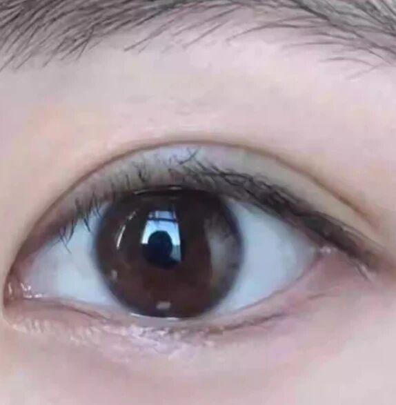 武汉做双眼皮的价格是多少？武汉做双眼皮效果好不好？