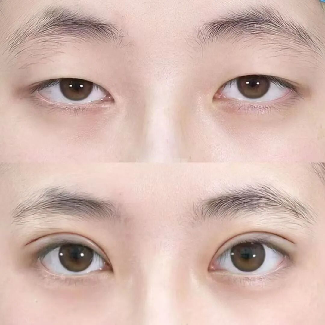 武汉做全切双眼皮价格?全切双眼皮价格和什么有关?