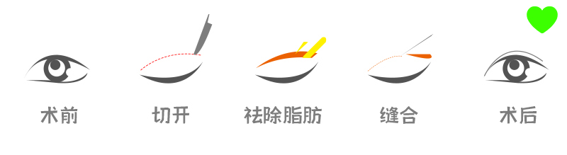 双眼皮手术多久能完全消肿？