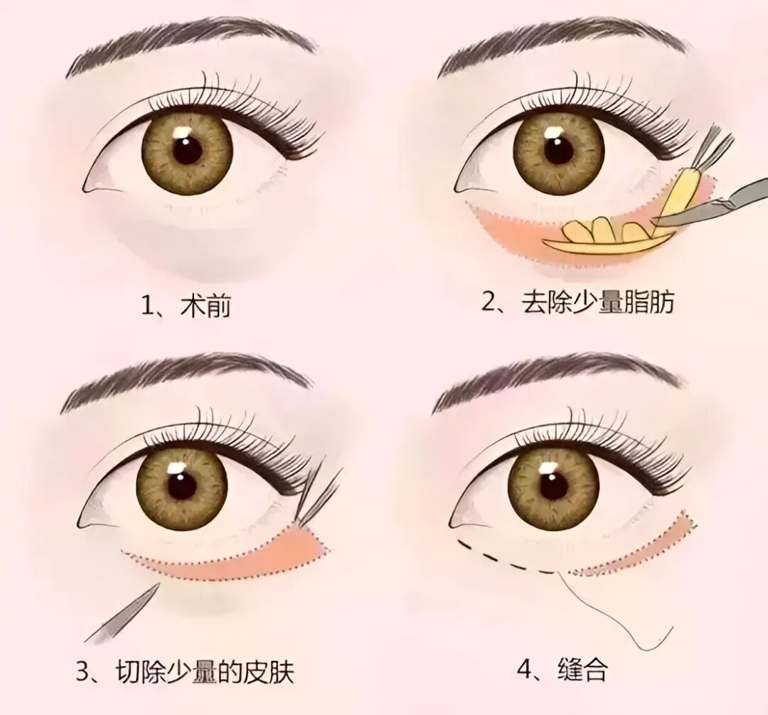 广州去眼袋整形医院排名！优选几位口碑好的医院分享