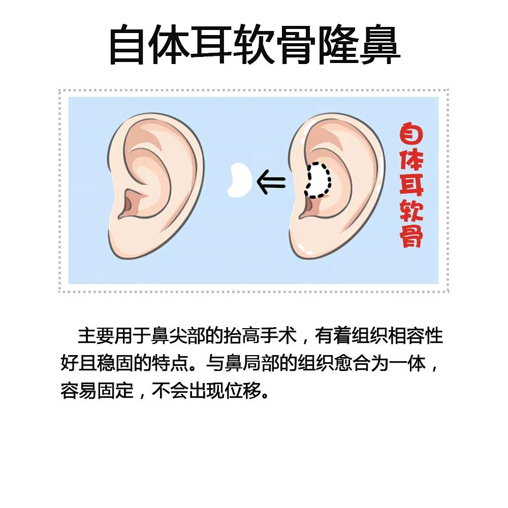耳软骨隆鼻大概多少钱?耳软骨隆鼻术后的注意事项