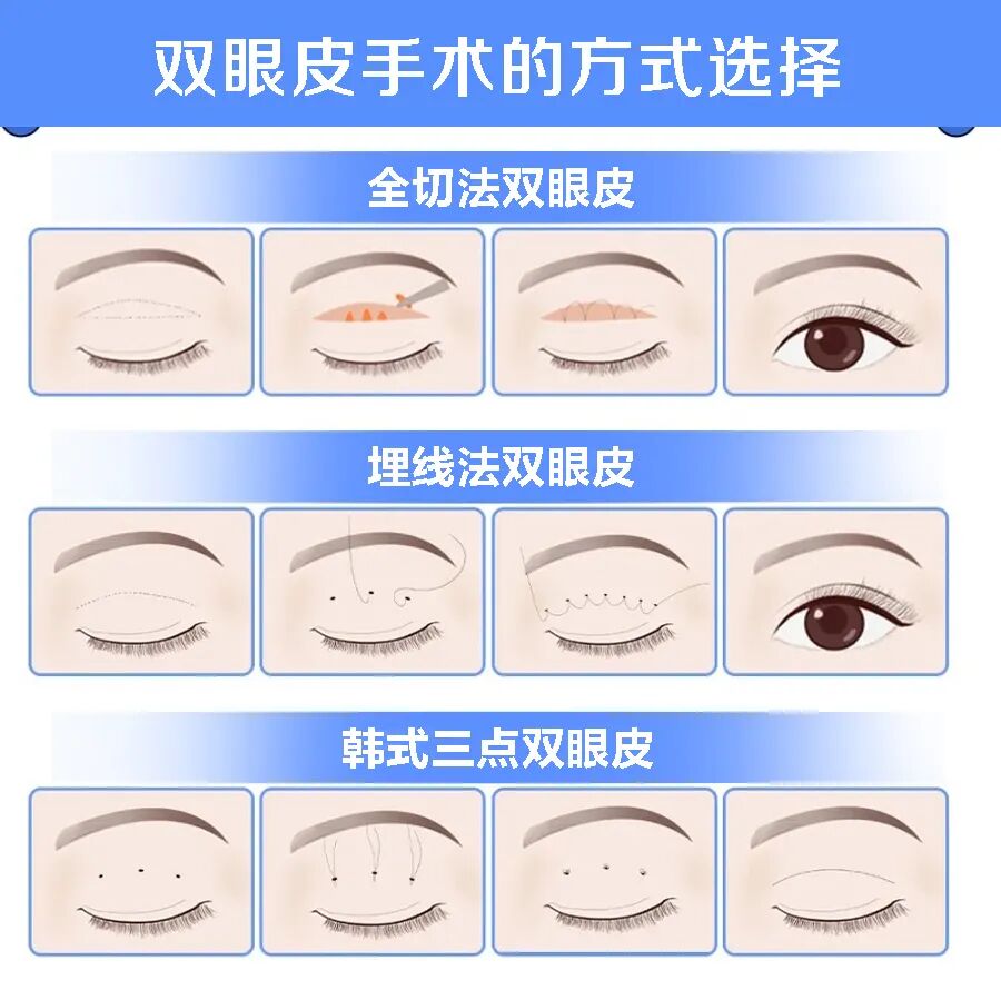 双眼皮基因是怎么遗传的？手术双眼皮都有哪些方法？
