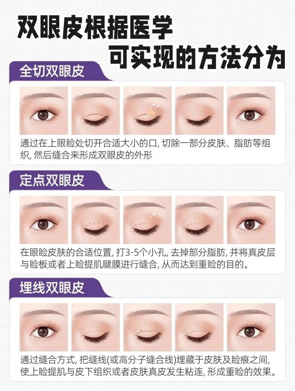 割双眼皮用哪些方法？双眼皮注意事项有哪些？