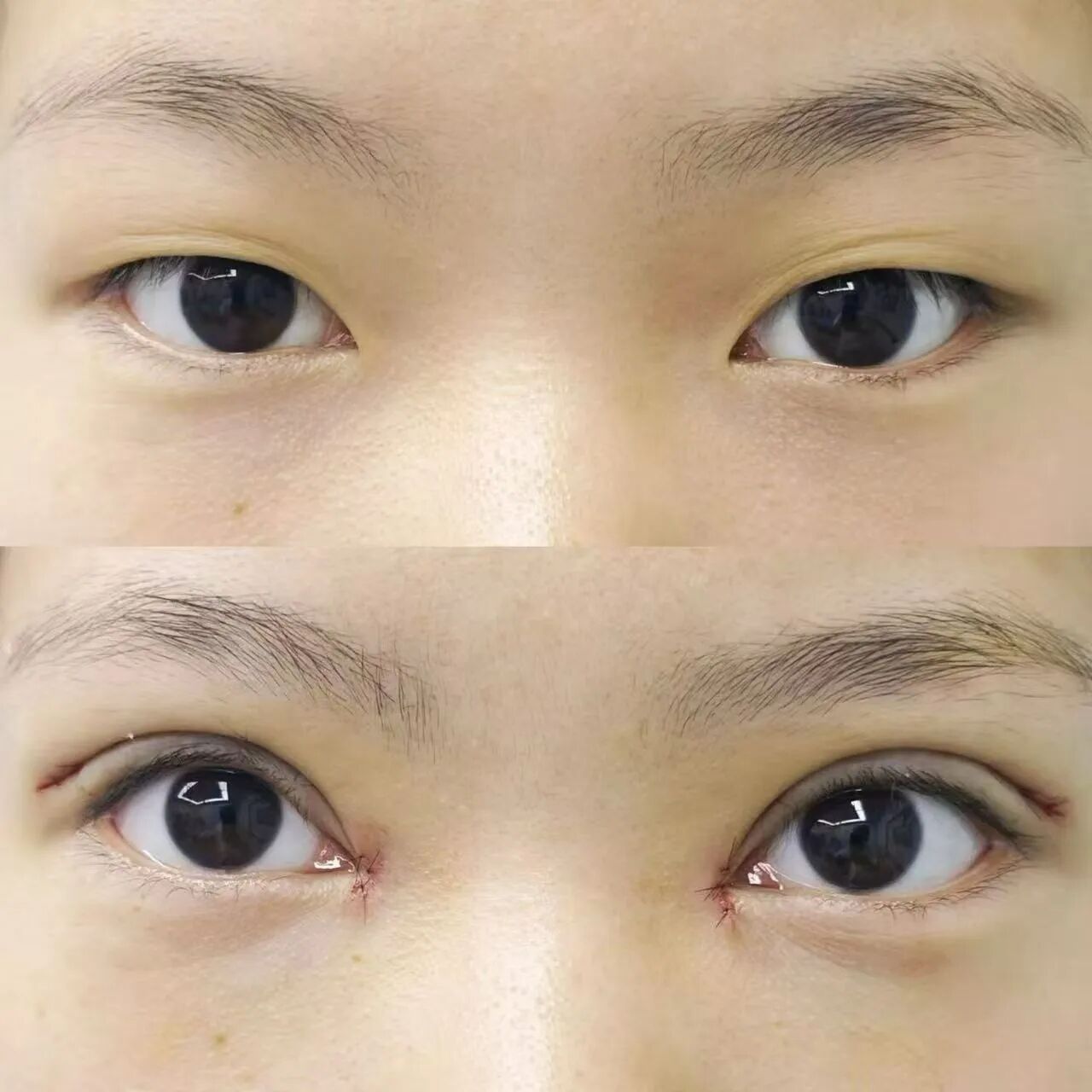 双眼皮有那些后遗症？割双眼皮有危险吗？