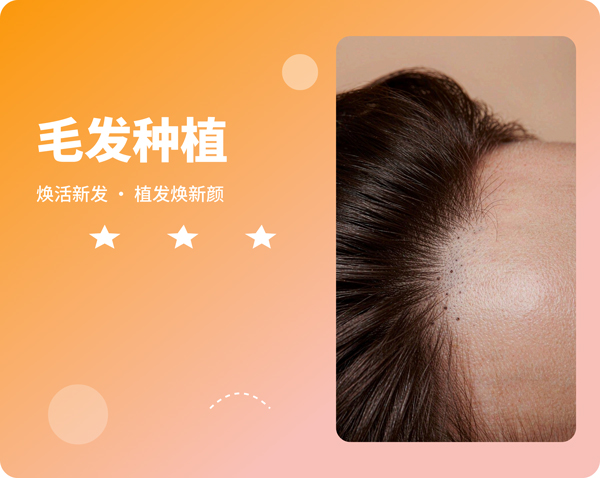 毛发种植