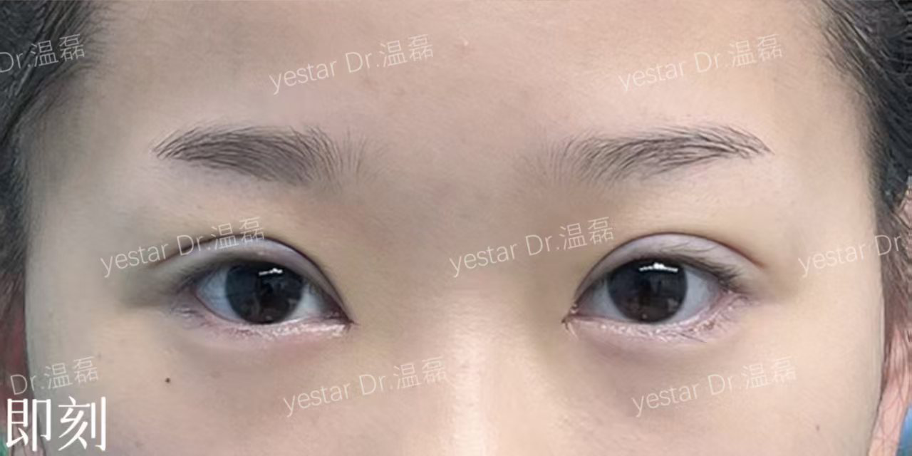 深圳双眼皮修复医院案例分享！附医院信息、医生介绍！
