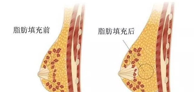自体脂肪隆胸有伤口吗？自体脂肪隆胸抽脂部位疼吗？