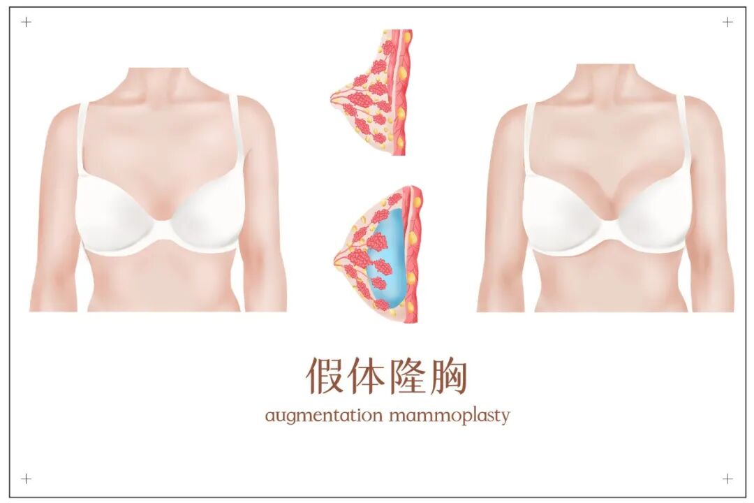 假体隆胸后的手感会不会硬？假体隆胸术后能不能运动？