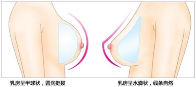 假体隆胸要多久才能恢复正常？假体隆胸手术后要怎么护理？