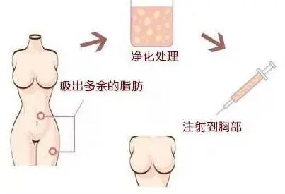 自体隆胸要多久才能恢复？自体隆胸会肿胀吗？
