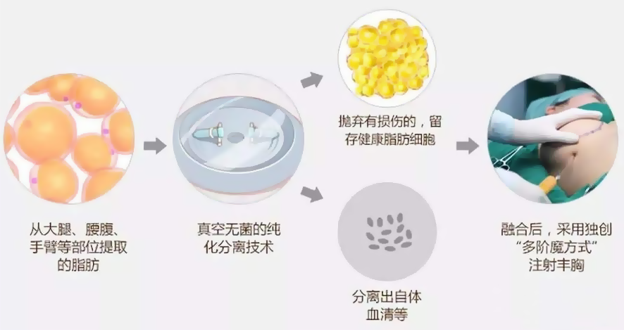 自体脂肪隆胸要做几次手术？自体脂肪隆胸做一次可以吗？
