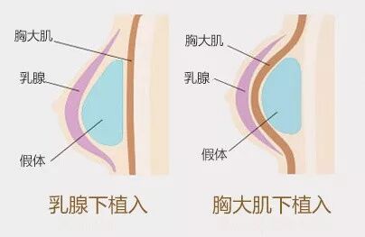 隆胸手术会造成乳腺结节吗？乳腺结节和隆胸有关系吗？