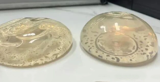 曼托假体可以放多长时间？曼托假体隆胸后可终生不取吗？